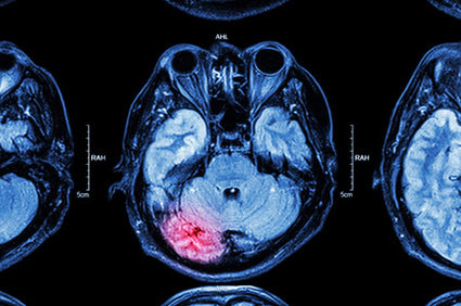 P&iacute;lula tripla ajuda sobreviventes de hemorragia intracerebral a atingirem suas metas de press&atilde;o arterial