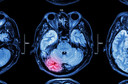 P&iacute;lula tripla ajuda sobreviventes de hemorragia intracerebral a atingirem suas metas de press&atilde;o arterial